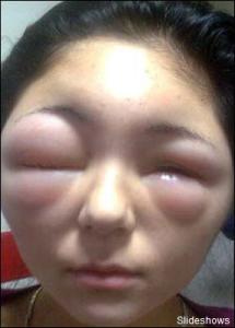 染发会过敏吗?怎么测试是否过敏?