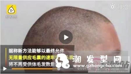 3D打印有望拯救脱发 无限量供应毛囊的速率生长毛囊