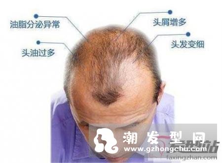 曝宋仲基因婚变脱发 婚变压力大脱发照曝光
