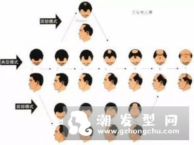 解决脱发问题，认清头发稀疏原因！
