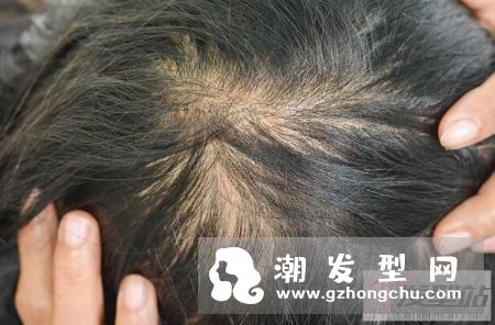 解决脱发问题，认清头发稀疏原因！