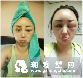 染发会过敏吗?怎么测试是否过敏?