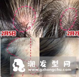 头皮长痘痘成因及解决方法，掉发严重、毛囊炎舒缓有感