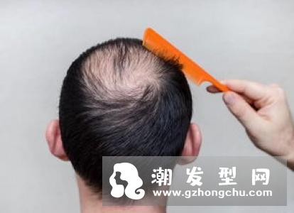 脱发可根据先天体质及后天生活习惯而有不同的分类