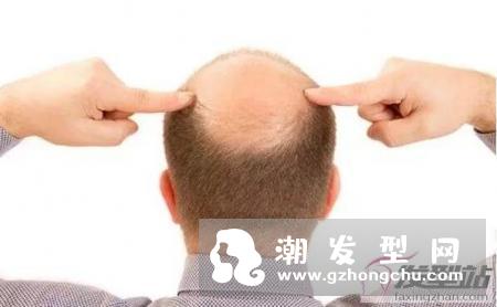 3D打印有望拯救脱发 无限量供应毛囊的速率生长毛囊