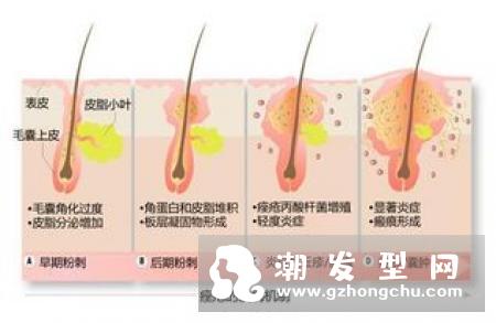 头皮长痘痘成因及解决方法，掉发严重、毛囊炎舒缓有感