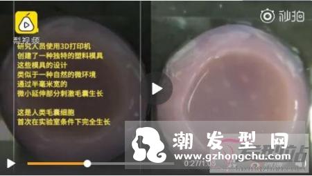3D打印有望拯救脱发 无限量供应毛囊的速率生长毛囊