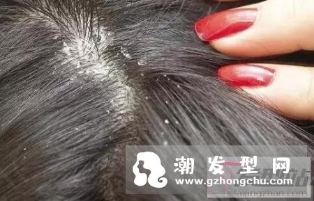 生姜水长期洗头,你怕是要得将头皮洗去一层皮的节奏?