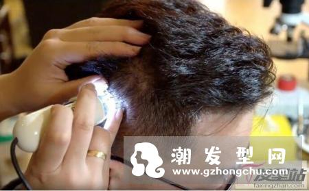 头皮上很多黑头粉刺怎么办 即学头皮清洁2大方法清洁头皮