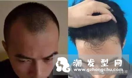 如何防止发际线后移 这个元凶很多人都不知道