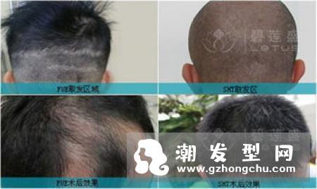 植发要多长时间 危害有哪些
