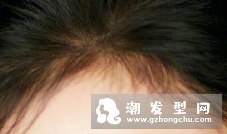 植发靠谱吗 植发的效果能保持多久