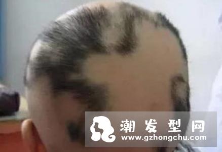 秃头少女踩雷汇总 你脱发的原因都在这里