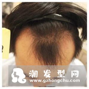 植发后可以上班吗 可以运动吗