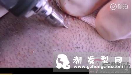 印度富商植发过敏身亡 植发的这些风险你和危害你必须懂