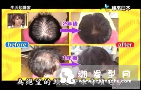头皮上很多黑头粉刺怎么办 即学头皮清洁2大方法清洁头皮