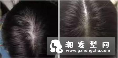 票选女性头皮最困扰问题 发根塌、脱发、头皮屑一次解决