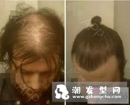 地中海发型怎么弄好看 男人秃顶适合什么发型