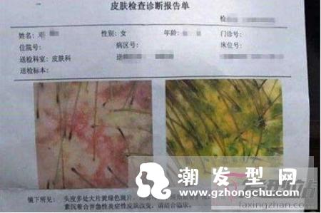 染发前要注意什么哪些人不适合染发？女子染发操作失败后被剃光头住院！