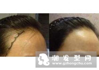 种植头发能保持几年 还会掉头发吗