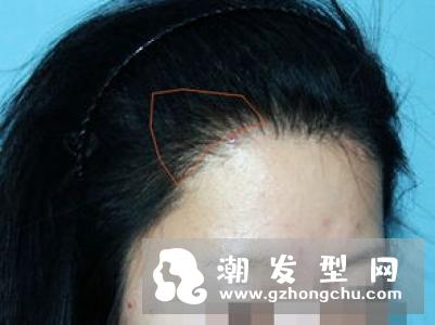 发际线高可以植发吗 不会掉吗