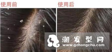 头发分线定死了怎么办 只要一把梳子 交叉发丝顽固万年发线立刻消失