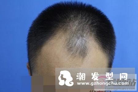 植发靠谱吗 植发的效果能保持多久