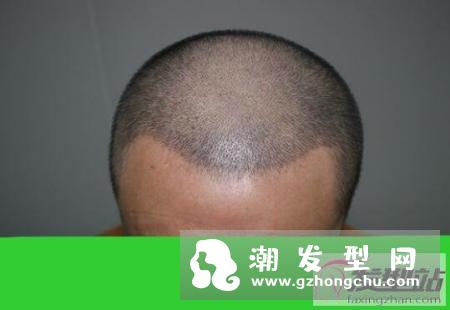 植发靠谱吗 植发的效果能保持多久