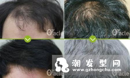 受头油、头屑、掉发困扰？解决烦恼从适当头皮护理开始