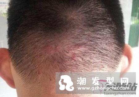 头皮上长痘痘和脓包痛又痒怎么办 快学正确抗痘方法避免引发秃头危机