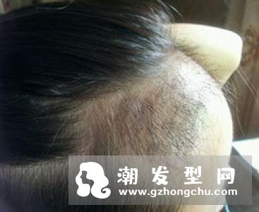 女性可以植发吗 哪些女性不能做