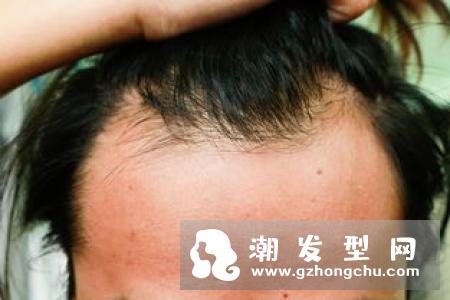 发际线高可以植发吗 不会掉吗