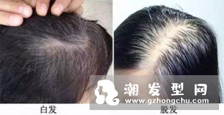 白发脱发的民间偏方 必须清楚了解自己体质对证施治