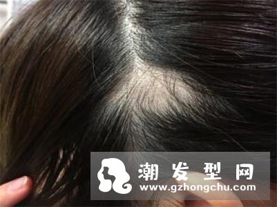 头发越来越稀疏? 留意6个你可能没想过的脱发原因