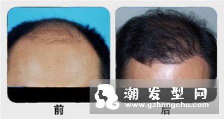 种植头发能保持几年 还会掉头发吗