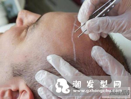 印度富商植发过敏身亡 植发的这些风险你和危害你必须懂