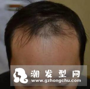 发际线高可以植发吗 不会掉吗