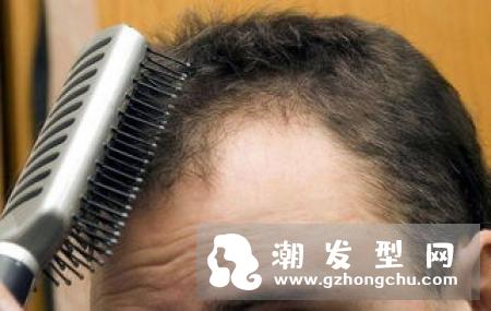 植发需要剃光头吗 一般多久见效