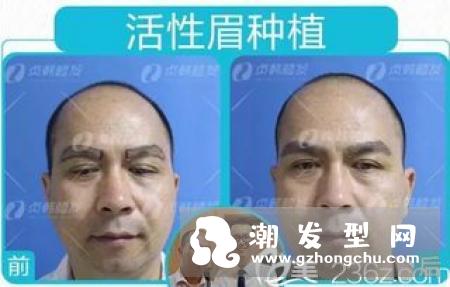 植发多少钱一根 明星为什么不植发