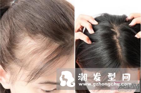 掉头发厉害怎么办 这些日常生活习惯真的很重要！