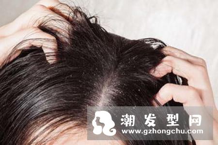 头皮上有臭头油味怎么办 请戒掉会加剧头臭头油头皮甚至脱发的坏习惯