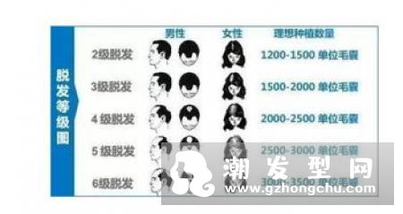 植发多少钱一根 明星为什么不植发
