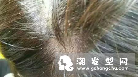 每天掉头发多少正常？一招教你辨别是否正常掉发！