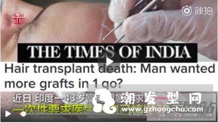 印度富商植发过敏身亡 植发的这些风险你和危害你必须懂