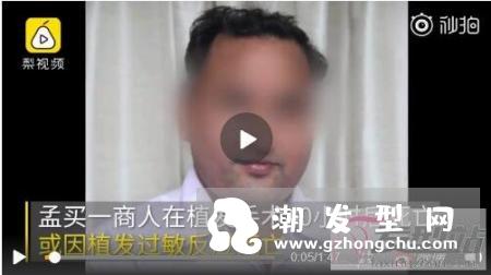印度富商植发过敏身亡 植发的这些风险你和危害你必须懂