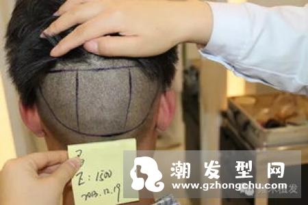 植发需要剃光头吗 一般多久见效