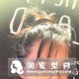 植发效果能维持多久 哪些人适合