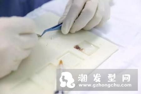 植发头部脑囊不足怎么办 可以用别人的头发吗