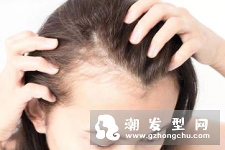 掉发与体“热”有关远离脂肪和胆固醇含量高的食物