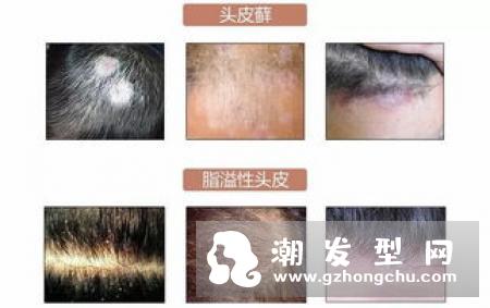 头皮发痒是什么原因 五个快速治头皮痒的方针